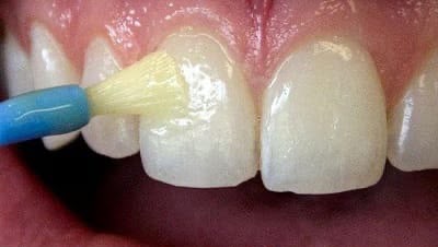 Teeth desensitizing treatment