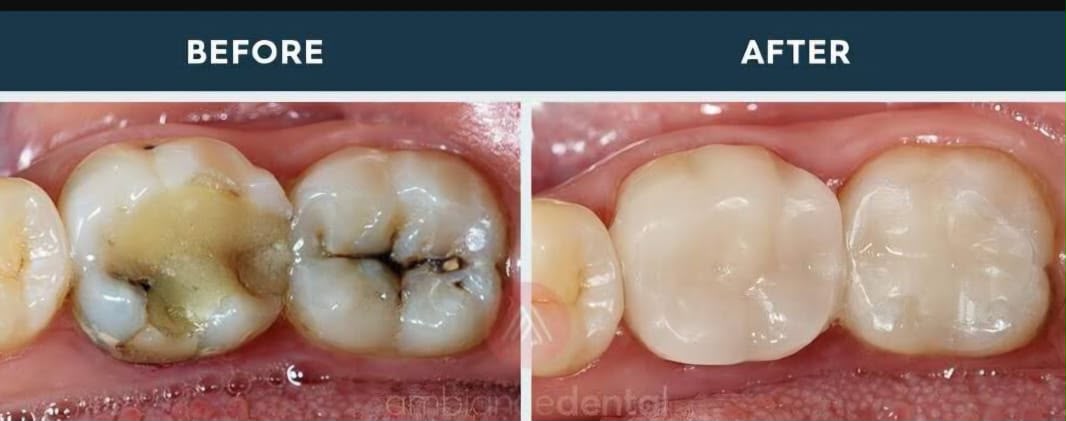 Dental filling treatment